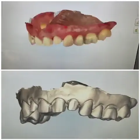 Escaneo Intraoral 3D en Vivo